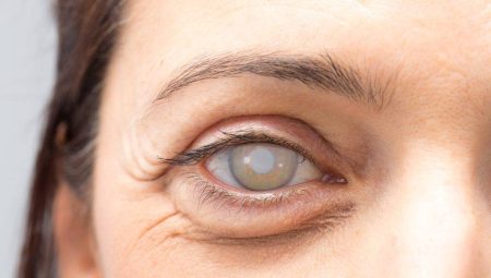 Tavuk Karası Hastalığı Tedavisi